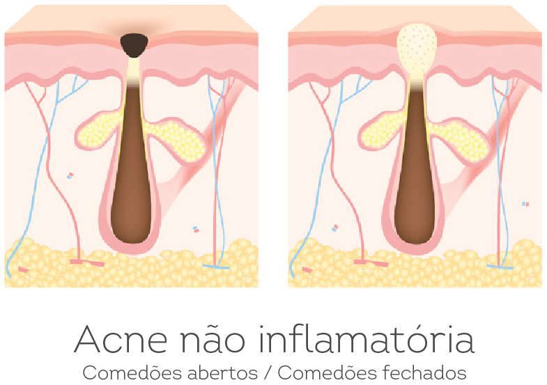 acne não inflamatória
