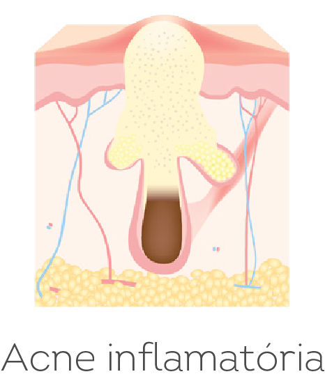 acne inflamatória