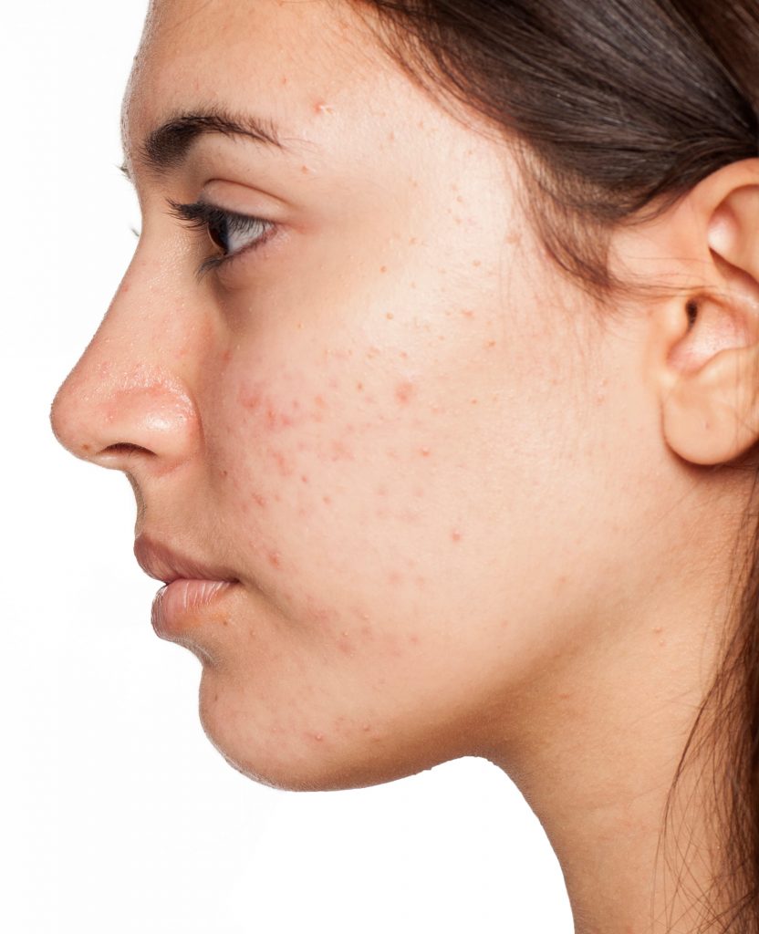 como a acne impacta na autoestima
