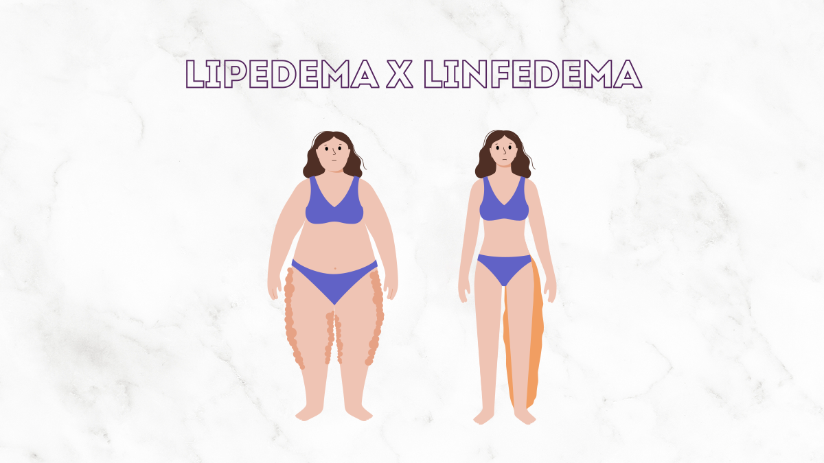 Lipedema e Linfedema: quais as diferenças